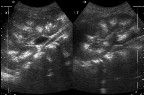 medullary sponge kidney ultrasound images.